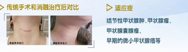 微波消融治疗仪