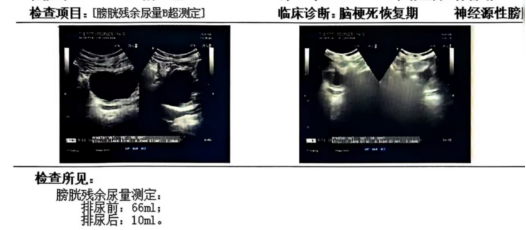 【医讯】青海省第五人民医院康复医学科开展神经源性膀胱功能障碍的评估及康复治疗